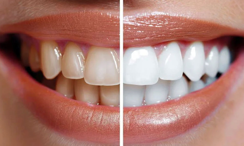 Отбеливание зубов Amazing White в Новосибирске: 6 шагов к здоровой белизне